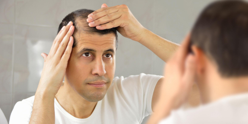 A Middle Age man Concerned About His Hair Loss InFront Of The Mirror.
