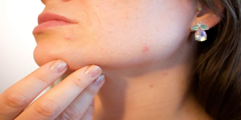 A Young Woman Show Her Acne To The Dermatologist.