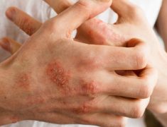 A Man Having So Much Of Rashes On His Hand.