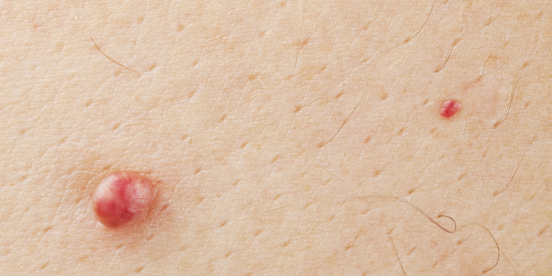 A Close-up Image Of Pimples On Skin.